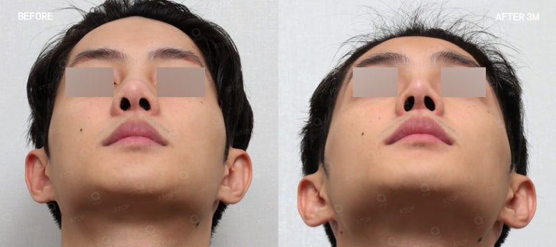 기능코성형, 코 모양은 물론 숨길을 함께 고려해야 하는 이유