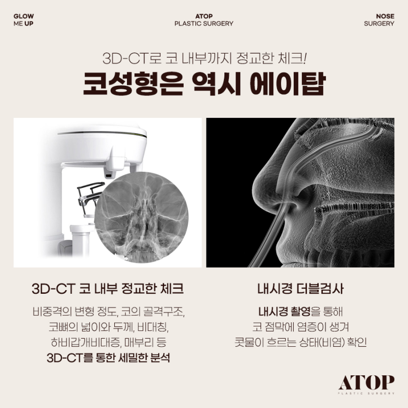 기능코성형, 코 모양은 물론 숨길을 함께 고려해야 하는 이유 사진 4