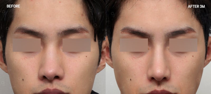기능코성형, 코 모양은 물론 숨길을 함께 고려해야 하는 이유 사진 6