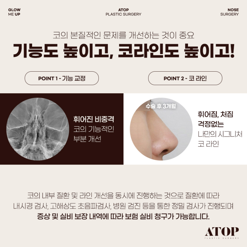 기능코성형, 코 모양은 물론 숨길을 함께 고려해야 하는 이유
