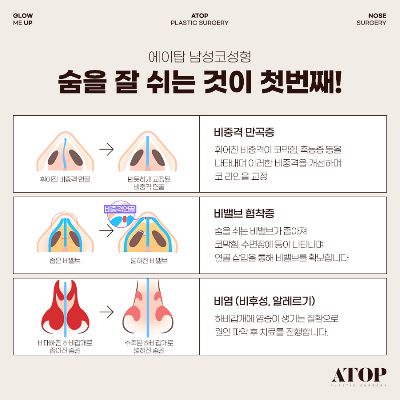 기능코성형, 코 모양은 물론 숨길을 함께 고려해야 하는 이유 사진 5