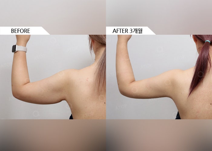 팔뚝지방흡입, 지방을 많이 빼는 것보다 중요한 건 매끄러운 라인