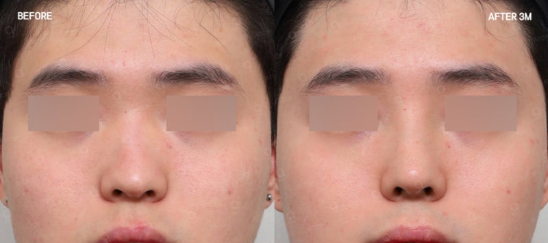 تجميل الأنف بالغضروف الضلعي الذاتي: دقة تتناغم مع ملامح أنفك 사진 4