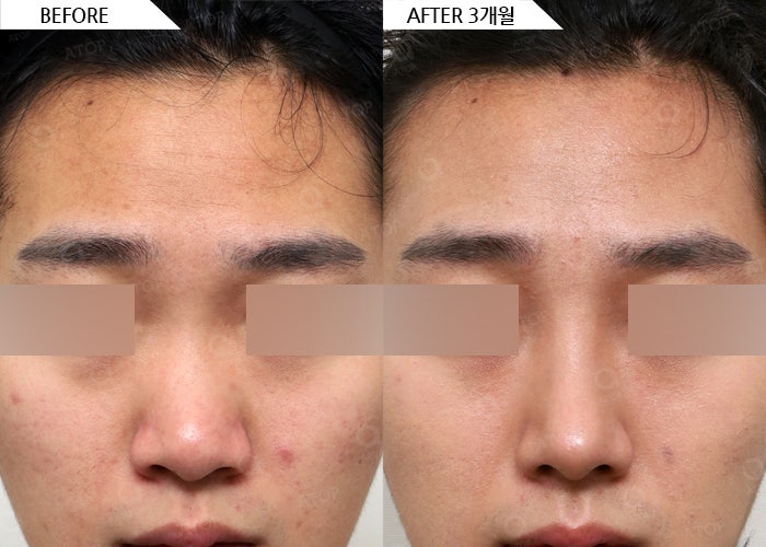 تجميل الأنف بالغضروف الضلعي الذاتي: دقة تتناغم مع ملامح أنفك 사진 7